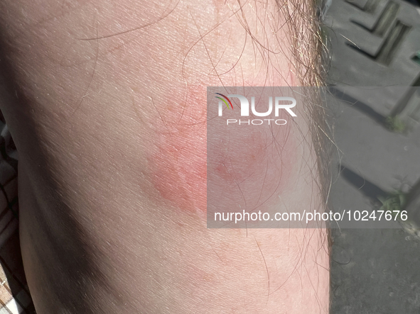 Tick bite on the forearm of a man in Toronto, Ontario, Canada, on July 07, 2023. Experts predict bad year for ticks as disease-carrying bugs...