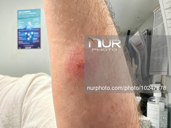 Tick bite on the forearm of a man in Toronto, Ontario, Canada, on July 07, 2023. Experts predict bad year for ticks as disease-carrying bugs...