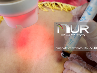 

A doctor at a traditional Chinese medicine clinic is performing suspension moxibustion and pot moxibustion treatment for citizens in Zaozh...