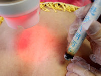 

A doctor at a traditional Chinese medicine clinic is performing suspension moxibustion and pot moxibustion treatment for citizens in Zaozh...