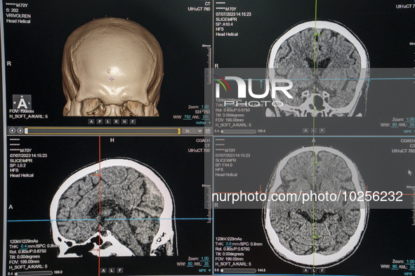 A General view showing a display screen showing a CT Scan of a brain inside the Central Government-aided Emergency Hospital on July 11, 2023...