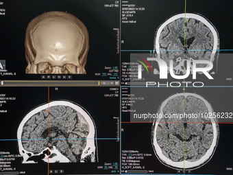 A General view showing a display screen showing a CT Scan of a brain inside the Central Government-aided Emergency Hospital on July 11, 2023...