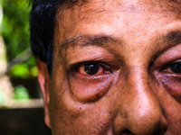 Amid heavy rainfall in West Bengal over the past few weeks, numerous cases of conjunctivitis are being reported per day. Conjunctivitis, or...