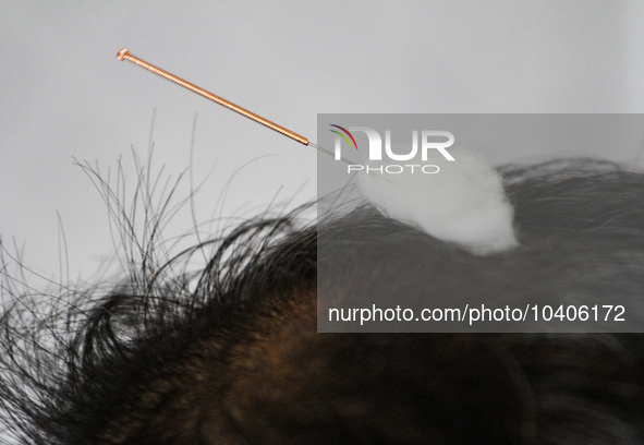 LINYI, CHINA - AUGUST 25, 2023 - A villager performs balanced acupuncture in the health room of Yanglou Village, Tancheng Street, Tancheng C...