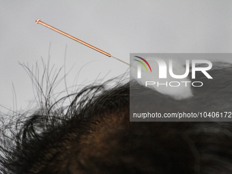 LINYI, CHINA - AUGUST 25, 2023 - A villager performs balanced acupuncture in the health room of Yanglou Village, Tancheng Street, Tancheng C...