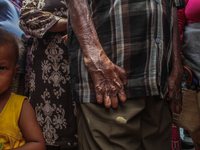 A child is seen within the leper community mass, which is protesting against the stigma and neglect at the North Sumatra Governor's office i...