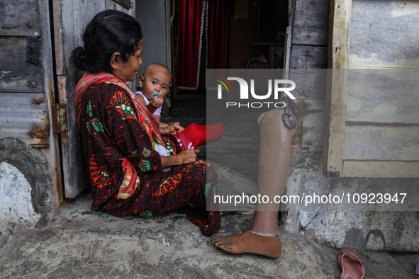 A leper woman is caring for her daughter at the Sicanang leprosy settlement in Medan, North Sumatra Province, Indonesia, on February 24, 201...