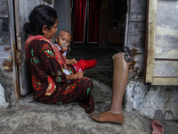 A leper woman is caring for her daughter at the Sicanang leprosy settlement in Medan, North Sumatra Province, Indonesia, on February 24, 201...