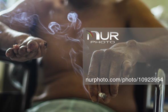 A patient with leprosy is smoking cigarettes during their hospitalization at Sicanang Leprosy Special Hospital in Medan, North Sumatra Provi...