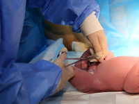 A medical worker is cutting the umbilical cord of a newborn ''dragon baby'' at the Maternity and Child Health Hospital in Zaozhuang, Shandon...