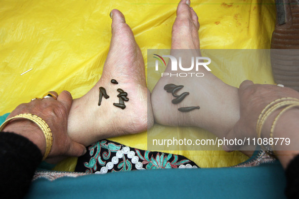 A local practitioner is placing leeches on the feet of a woman to suck impure blood as a means of skin treatment in celebration of Nowruz, t...