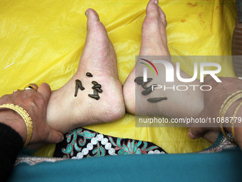 A local practitioner is placing leeches on the feet of a woman to suck impure blood as a means of skin treatment in celebration of Nowruz, t...