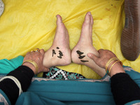 A local practitioner is placing leeches on the feet of a woman to suck impure blood as a means of skin treatment in celebration of Nowruz, t...