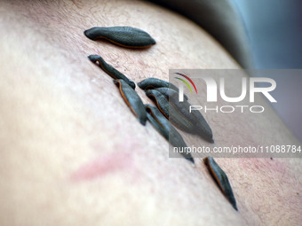 A local practitioner is placing leeches on the back of a man to suck impure blood as a means of skin treatment in celebration of Nowruz, the...