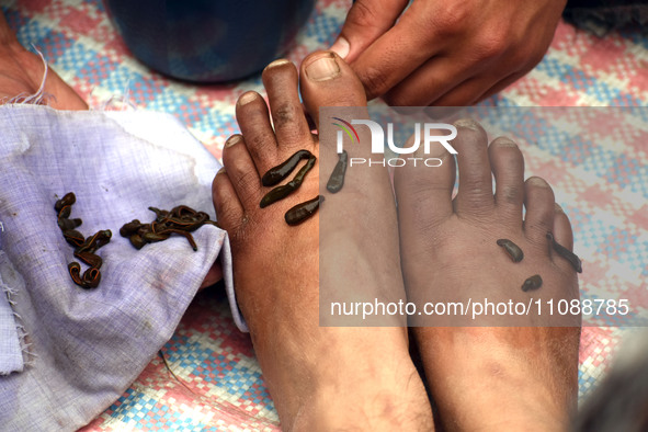 A local practitioner is placing leeches on the feet of a woman to suck impure blood as a means of skin treatment in celebration of Nowruz, t...