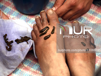 A local practitioner is placing leeches on the feet of a woman to suck impure blood as a means of skin treatment in celebration of Nowruz, t...