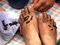 A local practitioner is placing leeches on the feet of a woman to suck impure blood as a means of skin treatment in celebration of Nowruz, t...