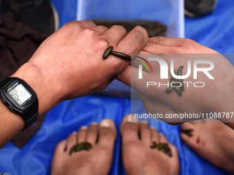 A local practitioner is placing leeches on the hands and feet of a man to suck impure blood as a means of skin treatment in celebration of N...