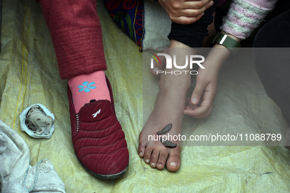 A local practitioner is placing leeches on the foot of a girl to suck impure blood as a means of skin treatment in celebration of Nowruz, th...