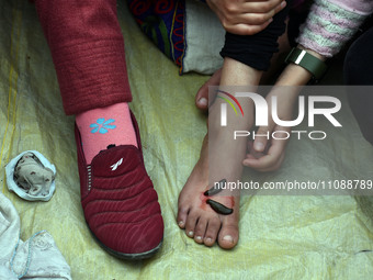 A local practitioner is placing leeches on the foot of a girl to suck impure blood as a means of skin treatment in celebration of Nowruz, th...