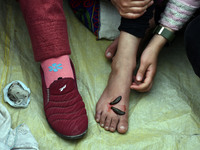 A local practitioner is placing leeches on the foot of a girl to suck impure blood as a means of skin treatment in celebration of Nowruz, th...