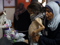 A Palestinian child is suffering from malnutrition and is receiving treatment at Al-Aqsa Martyrs Hospital in Deir al-Balah in the central Ga...