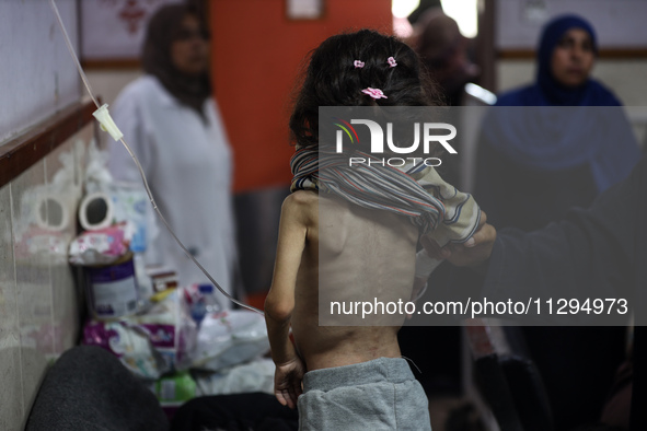 A Palestinian child is suffering from malnutrition and is receiving treatment at Al-Aqsa Martyrs Hospital in Deir al-Balah in the central Ga...