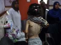 A Palestinian child is suffering from malnutrition and is receiving treatment at Al-Aqsa Martyrs Hospital in Deir al-Balah in the central Ga...