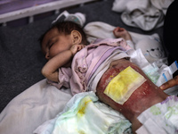 A Palestinian child is suffering from malnutrition and is receiving treatment at Al-Aqsa Martyrs Hospital in Deir al-Balah in the central Ga...