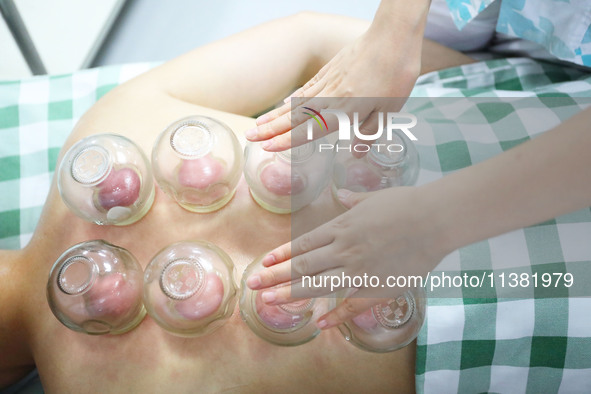 A doctor of acupuncture and massage at a traditional Chinese Medicine hospital is giving cupping treatment to a citizen in Chongqing, China,...