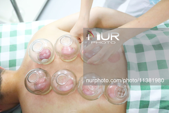 A doctor of acupuncture and massage at a traditional Chinese Medicine hospital is giving cupping treatment to a citizen in Chongqing, China,...