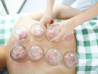 A doctor of acupuncture and massage at a traditional Chinese Medicine hospital is giving cupping treatment to a citizen in Chongqing, China,...