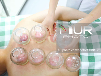 A doctor of acupuncture and massage at a traditional Chinese Medicine hospital is giving cupping treatment to a citizen in Chongqing, China,...