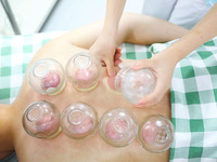 A doctor of acupuncture and massage at a traditional Chinese Medicine hospital is giving cupping treatment to a citizen in Chongqing, China,...