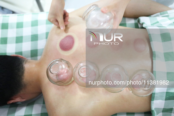 A doctor of acupuncture and massage at a traditional Chinese Medicine hospital is giving cupping treatment to a citizen in Chongqing, China,...