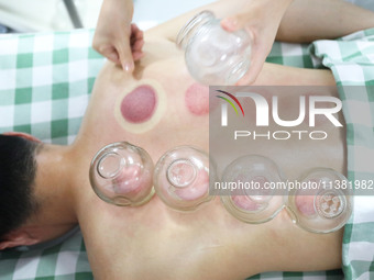 A doctor of acupuncture and massage at a traditional Chinese Medicine hospital is giving cupping treatment to a citizen in Chongqing, China,...