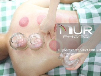 A doctor of acupuncture and massage at a traditional Chinese Medicine hospital is giving cupping treatment to a citizen in Chongqing, China,...