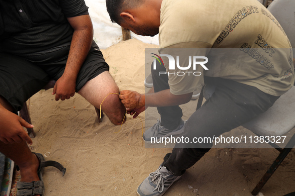 Muattaz Abu Dayeh, a physiotherapist, is applying a medical prosthesis to 32-year-old worker Majd al-Omari, who lost part of his leg during...