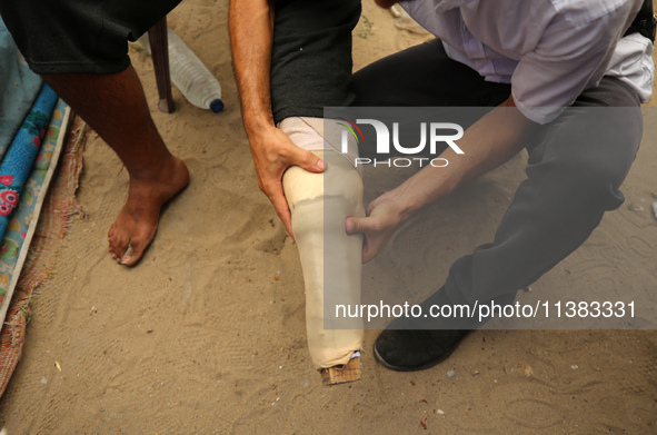 Muattaz Abu Dayeh, a physiotherapist, is applying a medical prosthesis to 32-year-old worker Majd al-Omari, who lost part of his leg during...