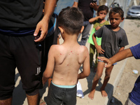 A Palestinian boy is suffering from a skin rash and is standing past a pool of sewage water on a street in Deir el-Balah in the central Gaza...