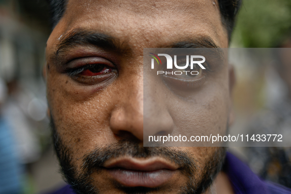 Mohammad Samrat is posing for a picture, showing his injury from police fire in front of Dhaka Medical College Hospital in Dhaka, Bangladesh...