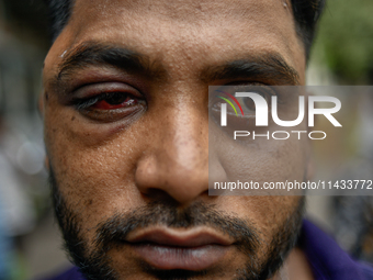 Mohammad Samrat is posing for a picture, showing his injury from police fire in front of Dhaka Medical College Hospital in Dhaka, Bangladesh...