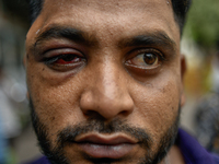 Mohammad Samrat is posing for a picture, showing his injury from police fire in front of Dhaka Medical College Hospital in Dhaka, Bangladesh...