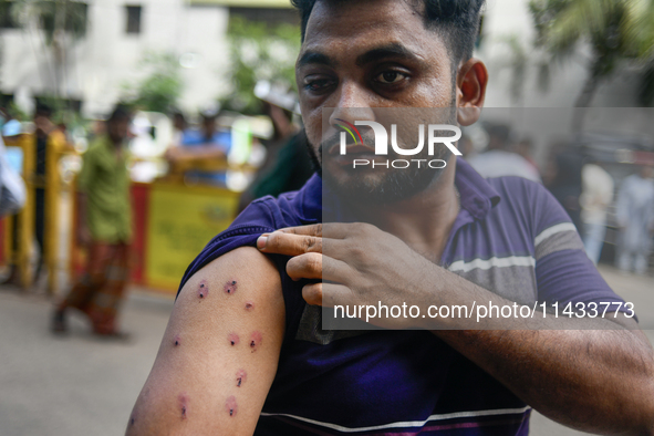 Mohammad Samrat is posing for a picture, showing his injury from police fire in front of Dhaka Medical College Hospital in Dhaka, Bangladesh...