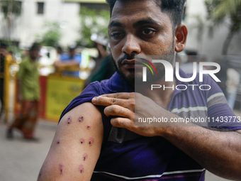 Mohammad Samrat is posing for a picture, showing his injury from police fire in front of Dhaka Medical College Hospital in Dhaka, Bangladesh...