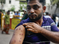 Mohammad Samrat is posing for a picture, showing his injury from police fire in front of Dhaka Medical College Hospital in Dhaka, Bangladesh...