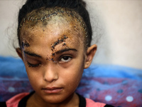 The Palestinian child Sila Houso, 7 years old, is being displaced from Gaza City to the central Gaza Strip. She is being injured during an I...