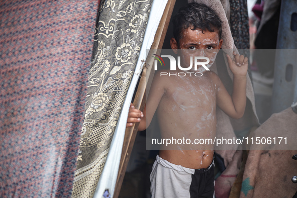 A Palestinian boy suffers from a skin rash at a makeshift camp for displaced Palestinians in Deir al-Balah, Gaza Strip, on August 24, 2024,...