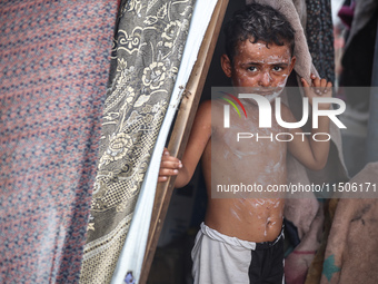 A Palestinian boy suffers from a skin rash at a makeshift camp for displaced Palestinians in Deir al-Balah, Gaza Strip, on August 24, 2024,...