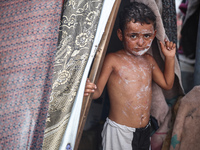 A Palestinian boy suffers from a skin rash at a makeshift camp for displaced Palestinians in Deir al-Balah, Gaza Strip, on August 24, 2024,...